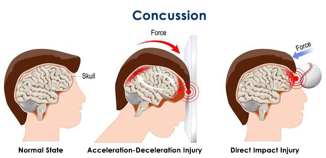 Concussion - Traumatic Head Injury